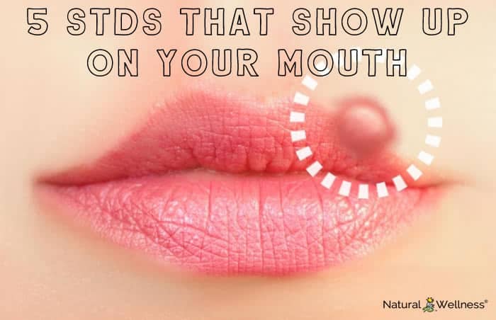 5 STDs That Show Up on Your Mouth