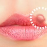 5 STDs That Show Up on Your Mouth