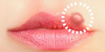 5 STDs That Show Up on Your Mouth and Lips