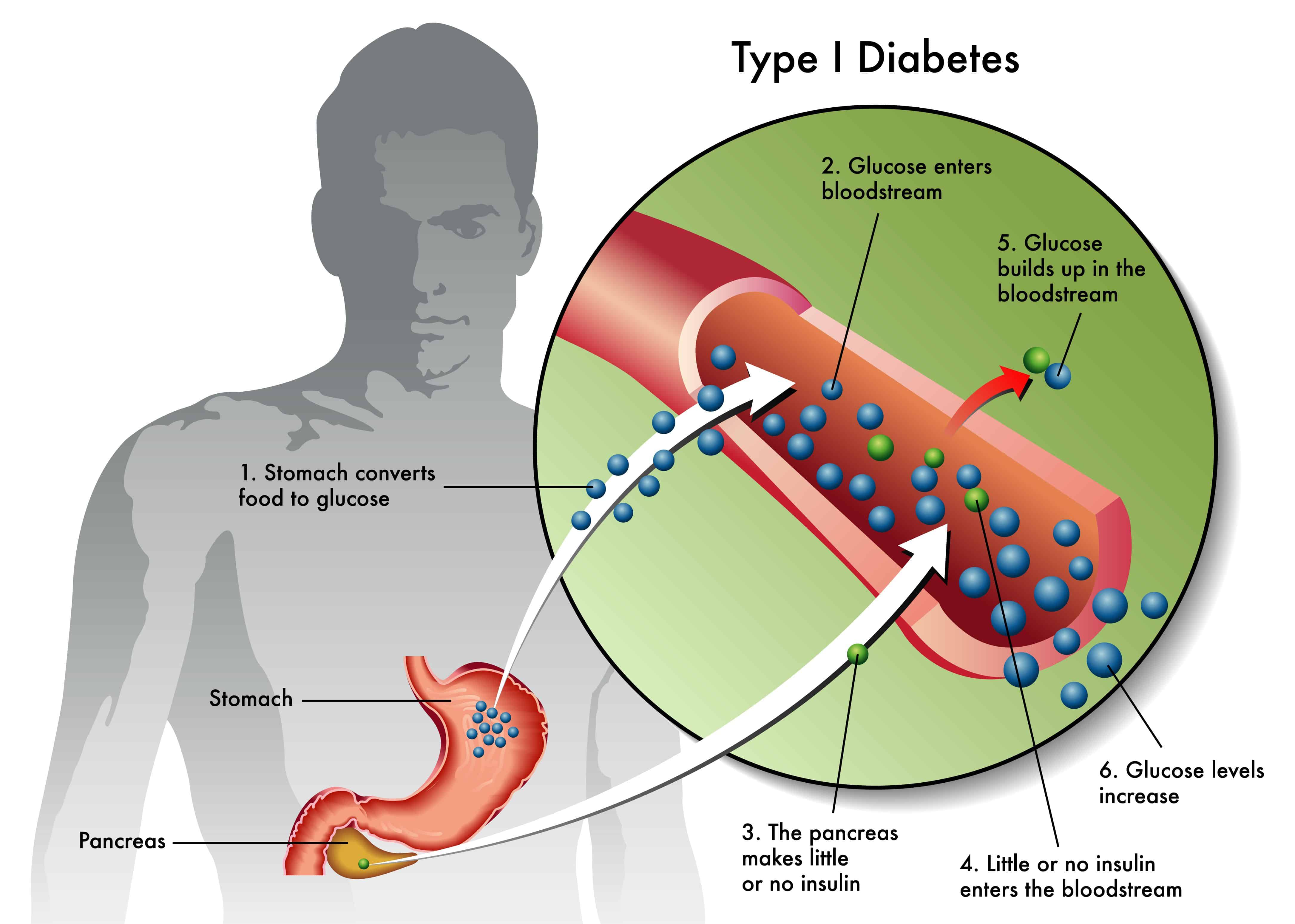 Регистр сахарного диабета 2024. Сахарный диабет 1-го типа. Сахарный диабет 2-го типа. Типы сахарного диабета 1 типа. Инсулинорезистентность клетки.