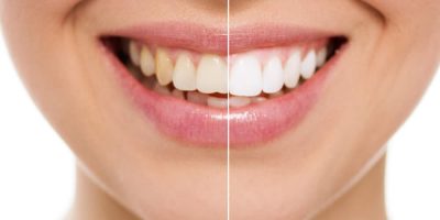 Turmeric for Teeth Whitening