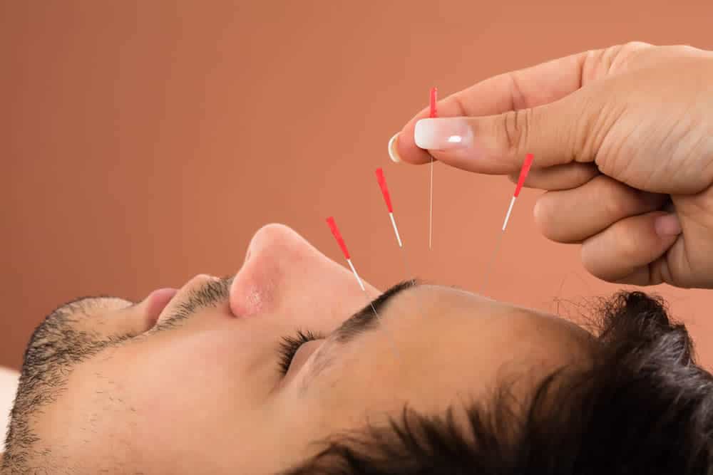 Acupuncture is a complementary and alternative medicince that can help relieve stress and pain.
