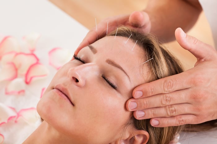 Acupunctuur kan migraine helpen verlichten.