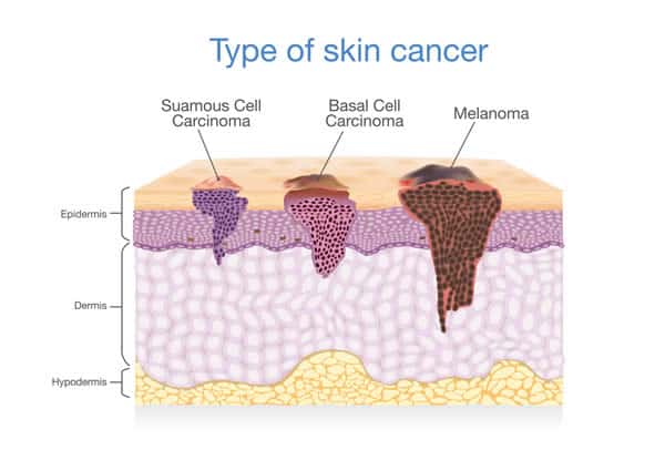 Three types of skin cancer.