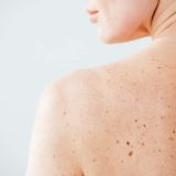 Boost Your Skin Cancer Awareness