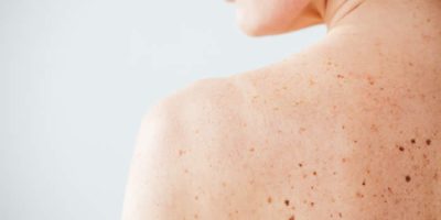Boost Your Skin Cancer Awareness