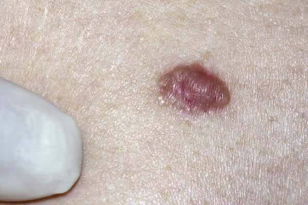 What does basal cell carcinoma look like?